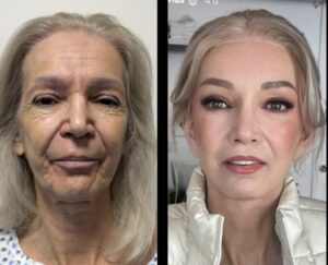 Facelift surgery by Dr. Carlos Mendez