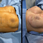 Breast augmentation at Mexico Transgender Center by Dr. Carlos Mendez