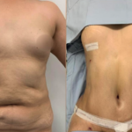Tummy tuck at Mexico Transgender Center by Dr. Carlos Mendez