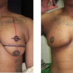 Double mastectomy (pre-op, post-op) by Dr. Carlos Mendez at Mexico Transgender Center