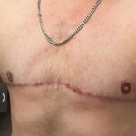 Double mastectomy (post-op) by Dr. Carlos Mendez at Mexico Transgender Center