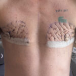Double mastectomy (post-op) by Dr. Carlos Mendez at Mexico Transgender Center