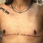 Double mastectomy (post-op) by Dr. Carlos Mendez at Mexico Transgender Center