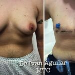 Double mastectomy (pre-op, post-op) by Dr. Carlos Mendez at Mexico Transgender Center