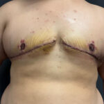 Double mastectomy (post-op) by Dr. Carlos Mendez at Mexico Transgender Center