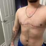 Double mastectomy (post-op) by Dr. Carlos Mendez at Mexico Transgender Center