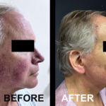 FFS (Type 3 forehead remodeling with hairline advancement, rhinoplasty, lip lift, facelift, neck lift) at MTC by Dr. Carlos Mendez