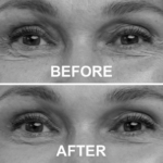 Blepharoplasty (lower eyelid surgery) at MTC by Dr. Carlos Mendez