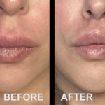 Upper lip lift surgery at Mexico Transgender Center by Dr. Carlos Mendez