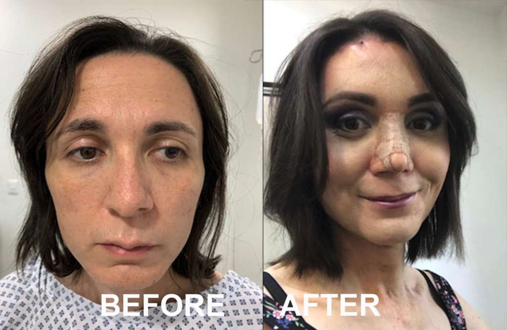 FFS (Type 3 forehead remodeling with hairline advancement, rhinoplasty, lip lift, cheek enhancement etc) at MTC by Dr. Carlos Mendez
