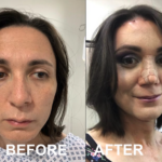 FFS (Type 3 forehead remodeling with hairline advancement, rhinoplasty, lip lift, cheek enhancement etc) at MTC by Dr. Carlos Mendez