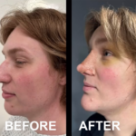 FFS (Type 3 forehead remodeling with hairline advancement, rhinoplasty, chin implant) at MTC by Dr. Carlos Mendez