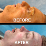 FFS (Type 3 forehead remodeling with hairline advancement, rhinoplasty, chin implant) at MTC by Dr. Carlos Mendez