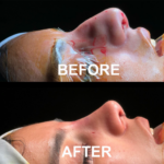 Facial Feminization surgery (rhinoplasty) at Mexico Transgender Center by Dr. Carlos Mendez