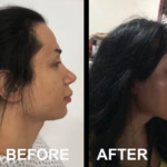 FFS (Type 3 forehead remodeling with hairline advancement, rhinoplasty, chin implant) at MTC by Dr. Carlos Mendez